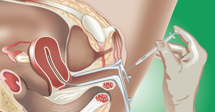 IUI Treatment Centre in Pune
