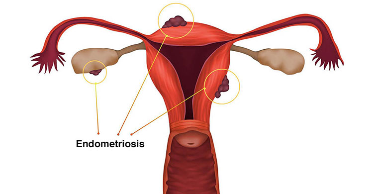 Endometriosis Endometriosis