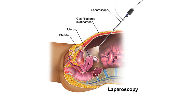 Laparoscopy