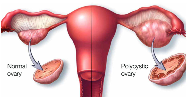 PCOD/PCOS Treatment
